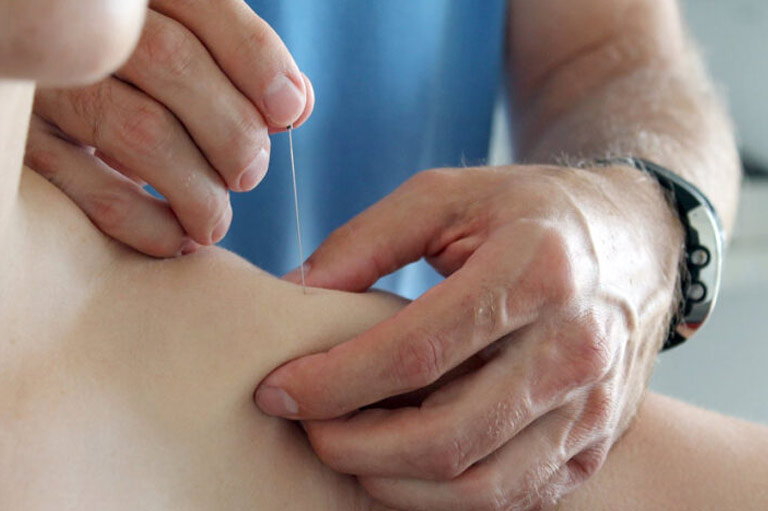 Dry Needling - Physio Wolkersdorf - Marion Thurn-Hofer